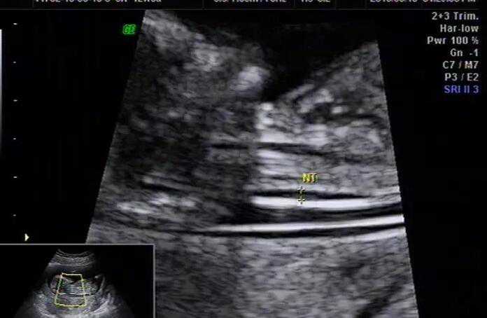 怀孕 切除子宫_切除子宫颈对生育_什么是试管婴儿？人工授精是怎么形成的？