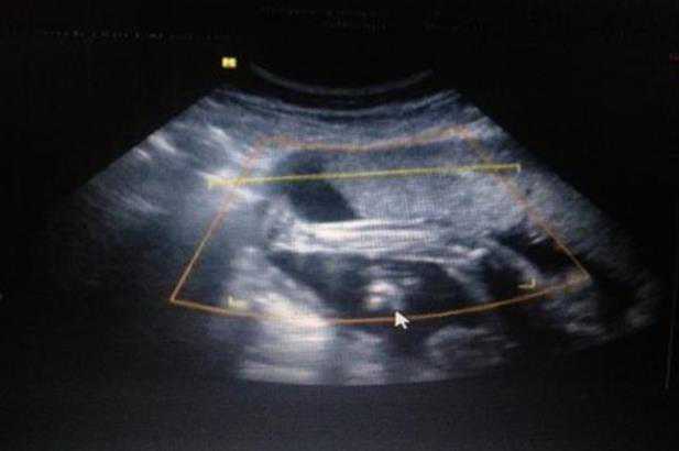 在切除子宫前怀孕_切除子宫 生育_美国试管婴儿整个流程是什么？这篇文章告诉